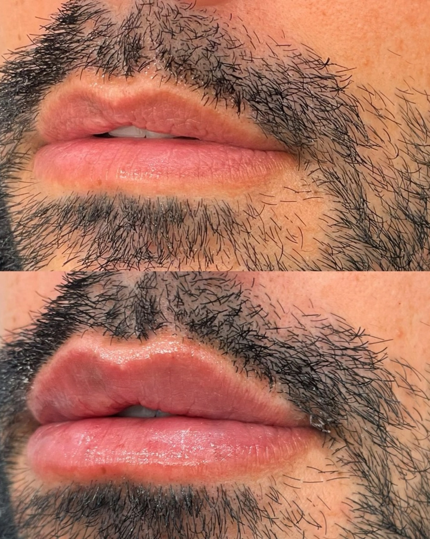 Real Patient Results by Motykie Med Spa serving Beverly Hills & Los Angeles, CA