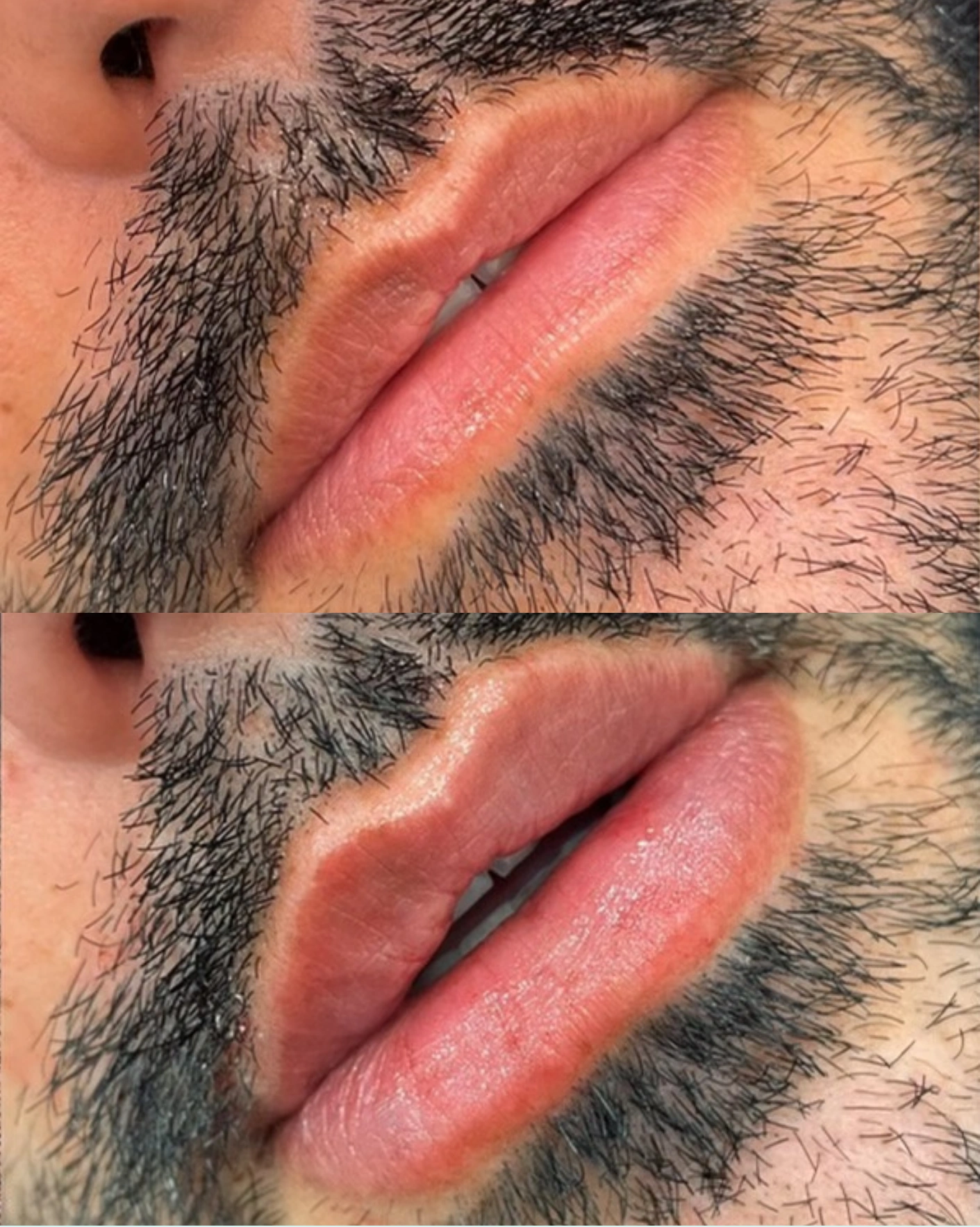 Real Patient Results by Motykie Med Spa serving Beverly Hills & Los Angeles, CA