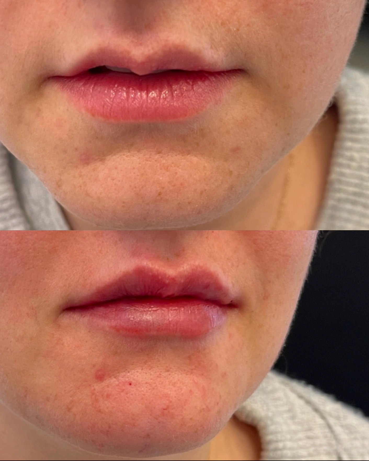 Real Patient Results by Motykie Med Spa serving Beverly Hills & Los Angeles, CA