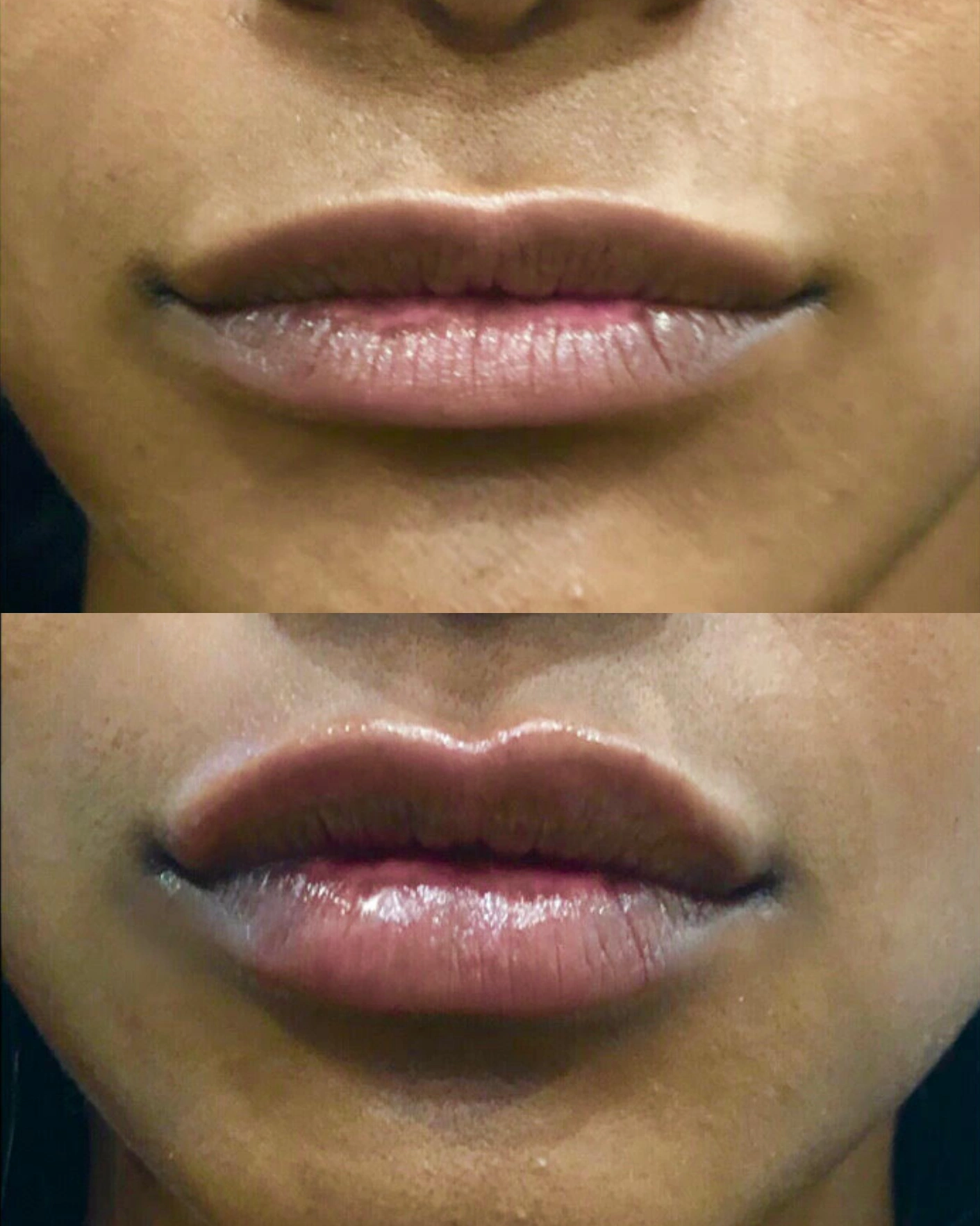 Real Patient Results by Motykie Med Spa serving Beverly Hills & Los Angeles, CA