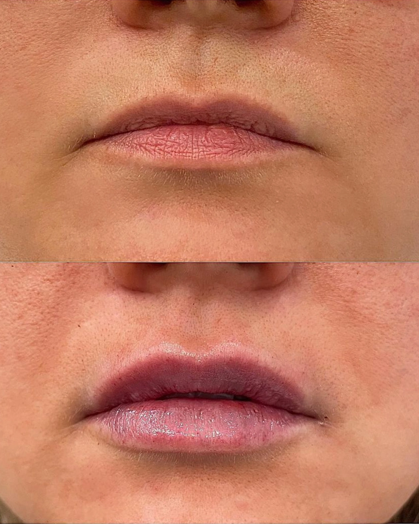 Real Patient Results by Motykie Med Spa serving Beverly Hills & Los Angeles, CA