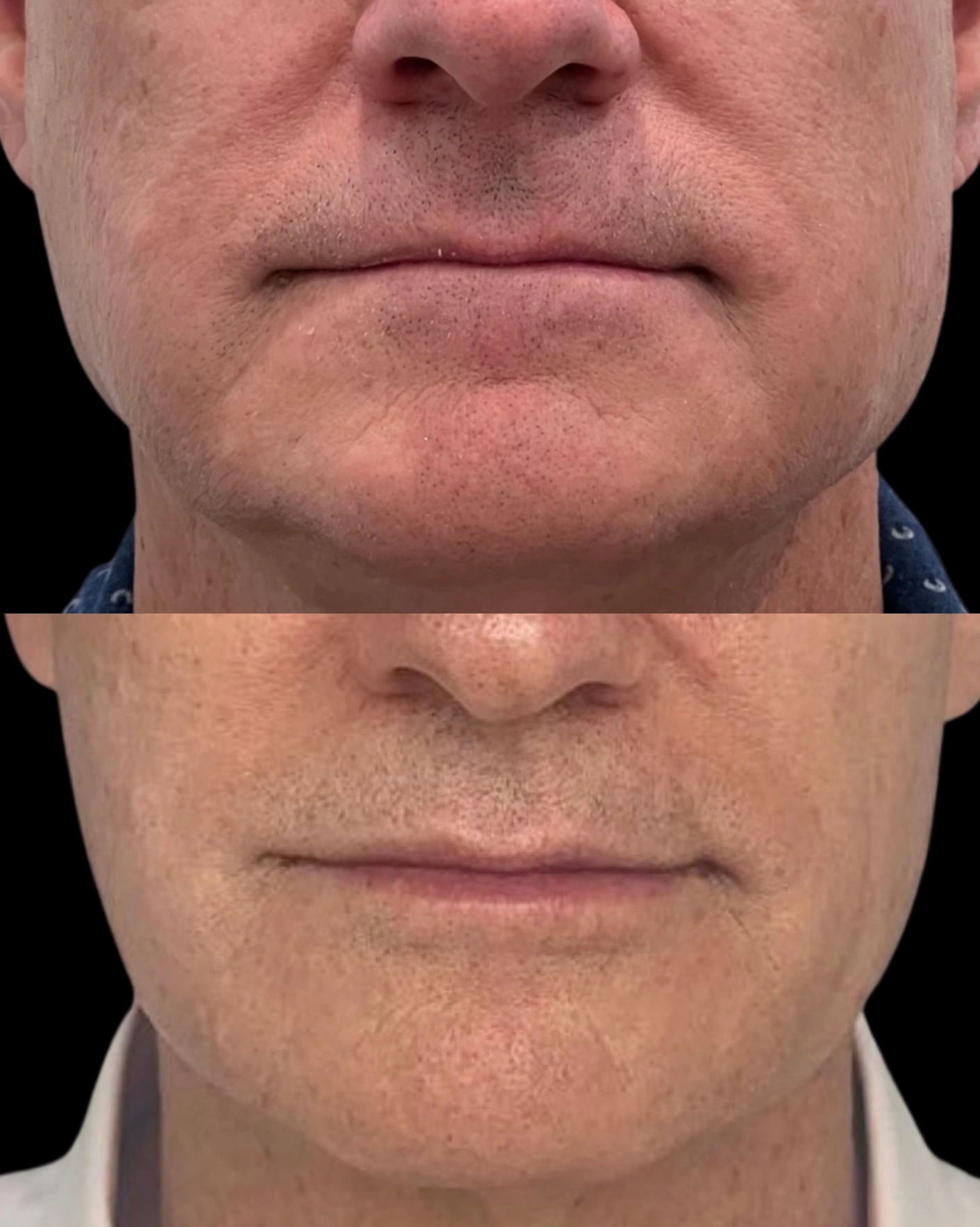 Real Patient Results by Motykie Med Spa serving Beverly Hills & Los Angeles, CA