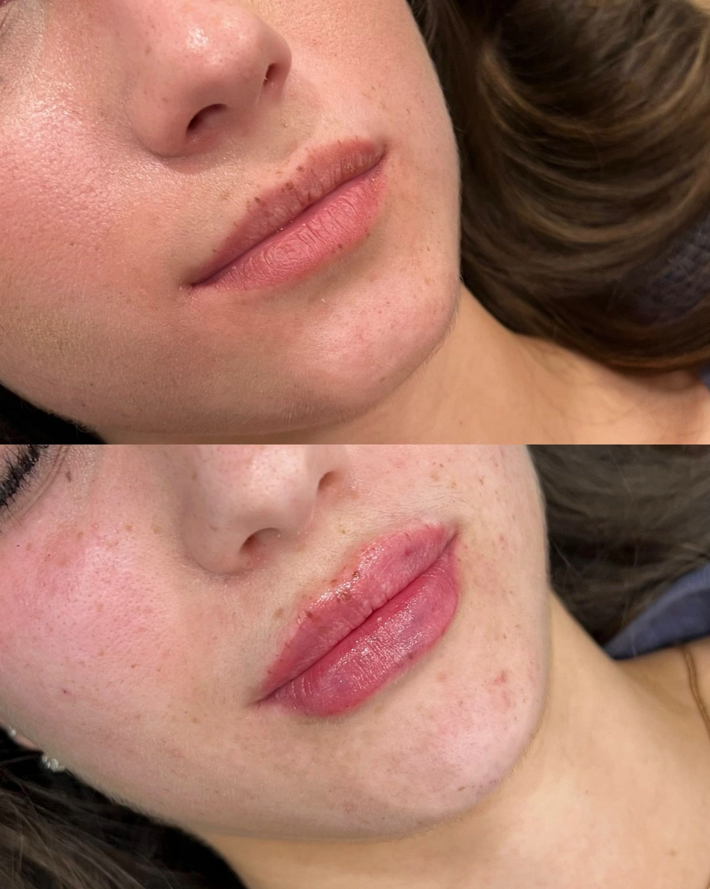 Real Patient Results by Motykie Med Spa serving Beverly Hills & Los Angeles, CA