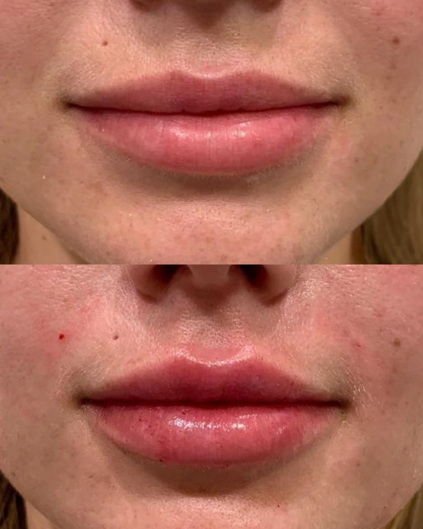 Real Patient Results by Motykie Med Spa serving Beverly Hills & Los Angeles, CA