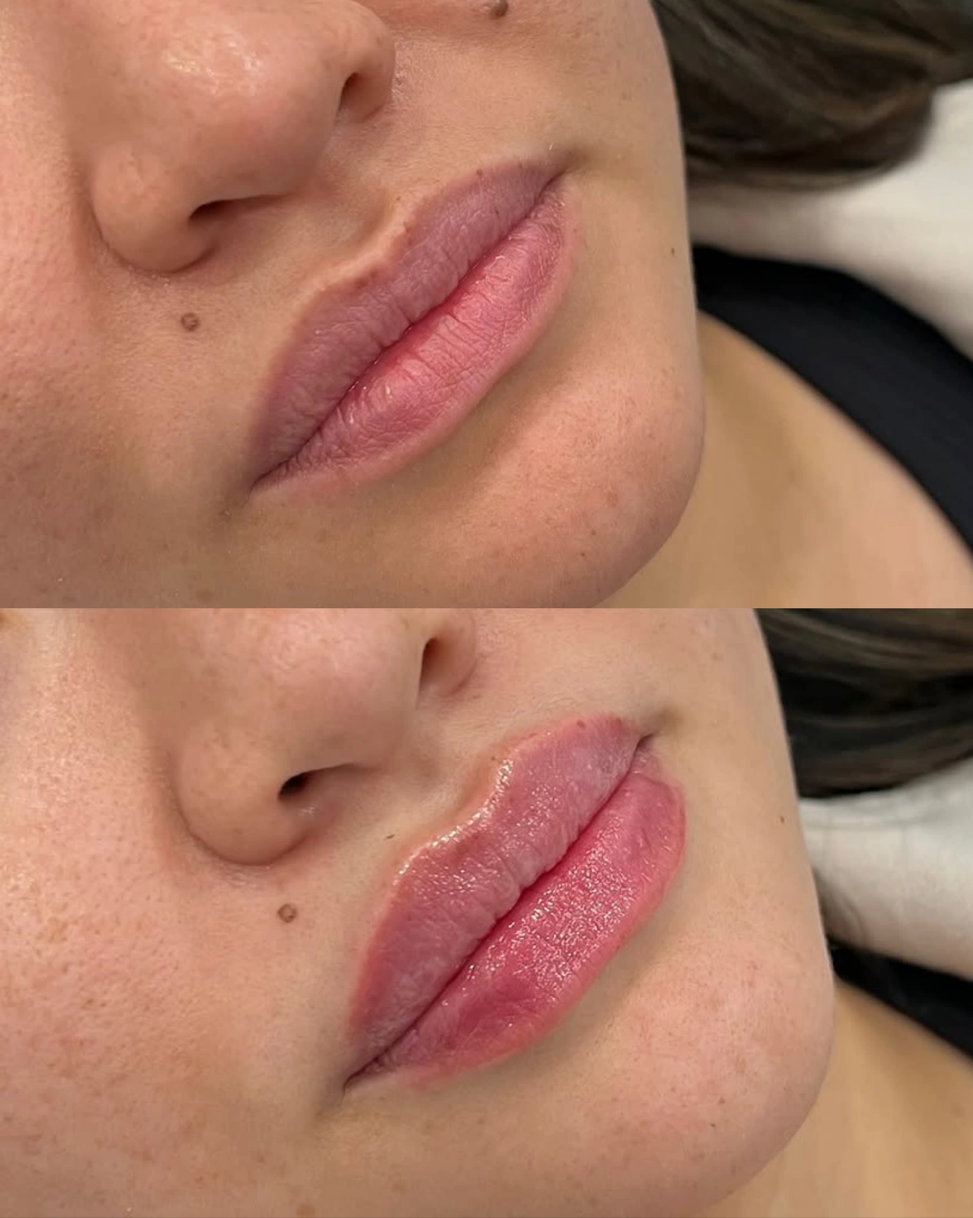 Real Patient Results by Motykie Med Spa serving Beverly Hills & Los Angeles, CA