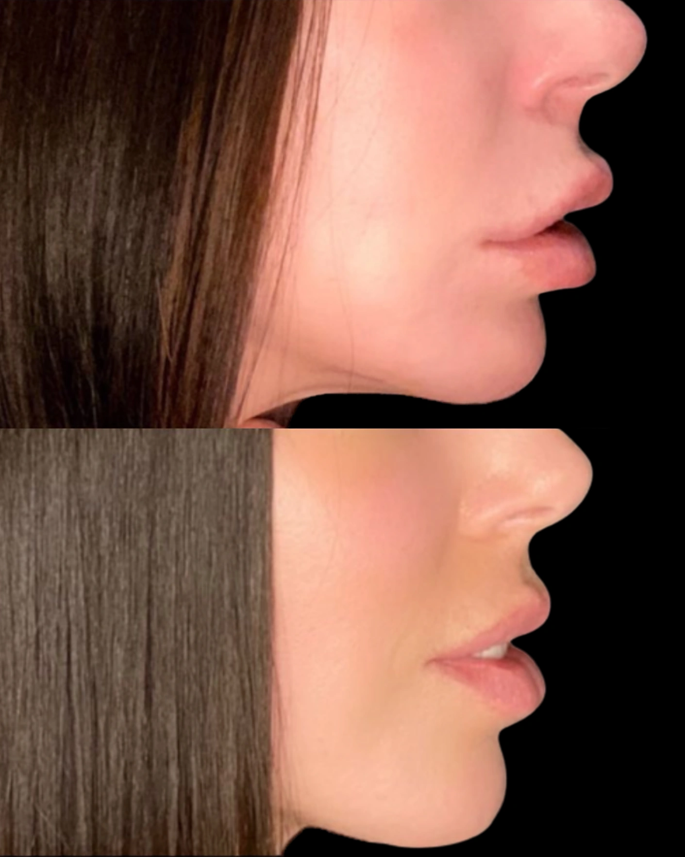 Real Patient Results by Motykie Med Spa serving Beverly Hills & Los Angeles, CA