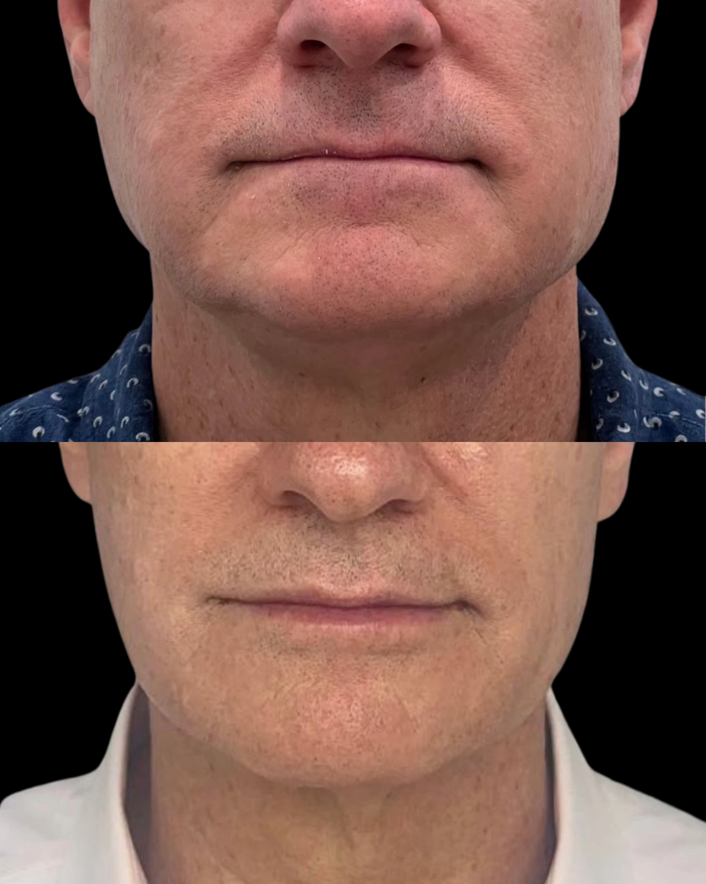 Real Patient Results by Motykie Med Spa serving Beverly Hills & Los Angeles, CA