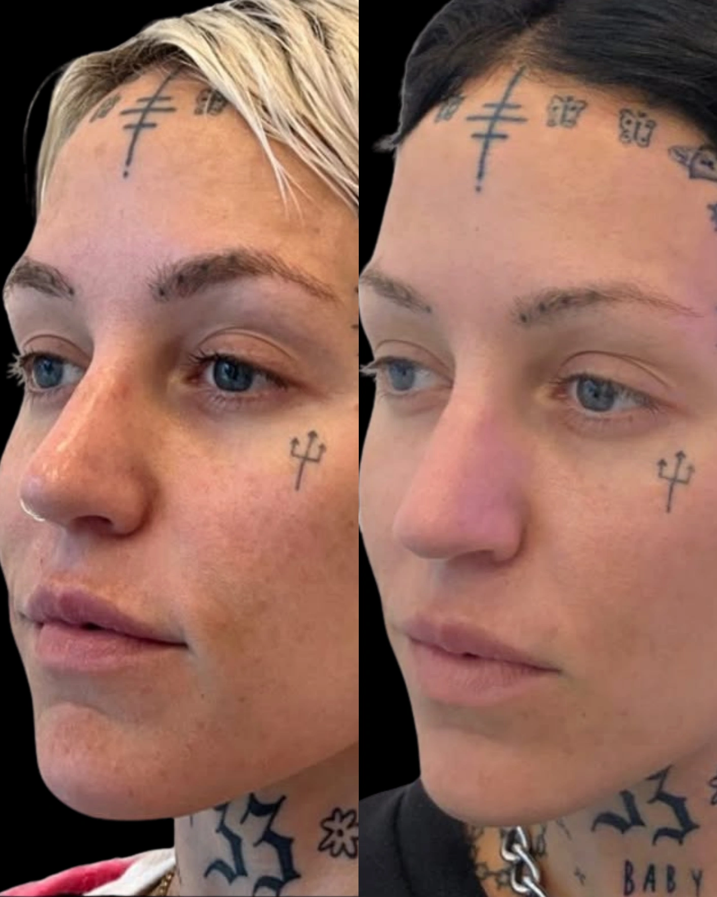 Real Patient Results by Motykie Med Spa serving Beverly Hills & Los Angeles, CA