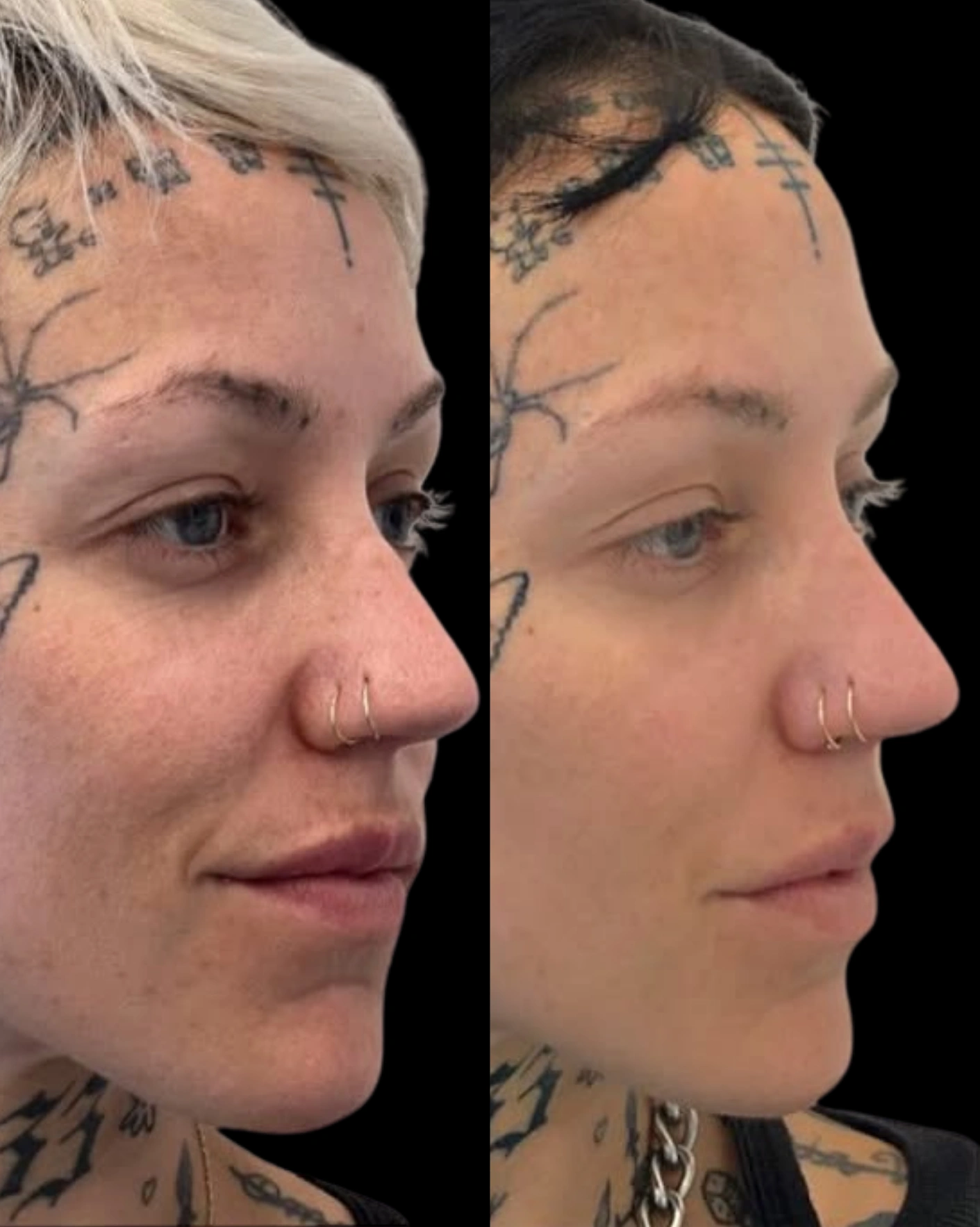 Real Patient Results by Motykie Med Spa serving Beverly Hills & Los Angeles, CA