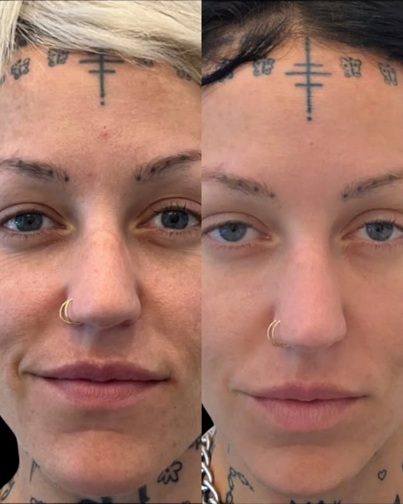 Real Patient Results by Motykie Med Spa serving Beverly Hills & Los Angeles, CA