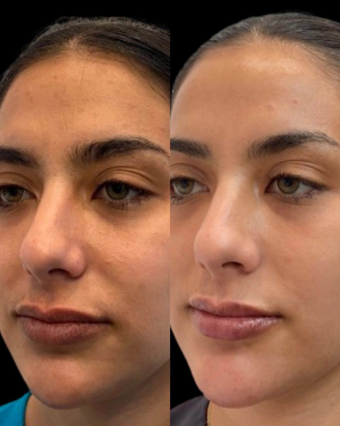 Real Patient Results by Motykie Med Spa serving Beverly Hills & Los Angeles, CA