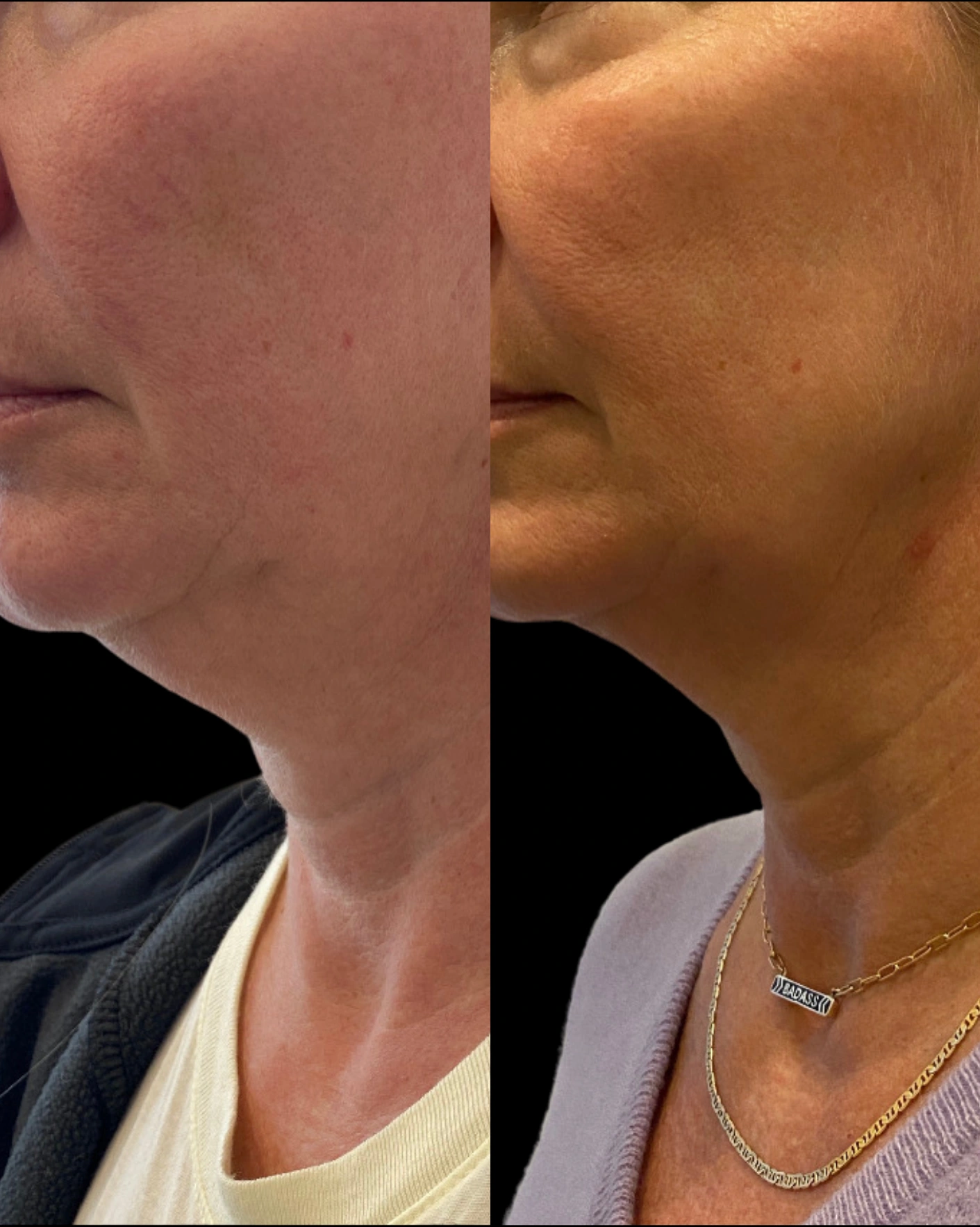 Real Patient Results by Motykie Med Spa serving Beverly Hills & Los Angeles, CA