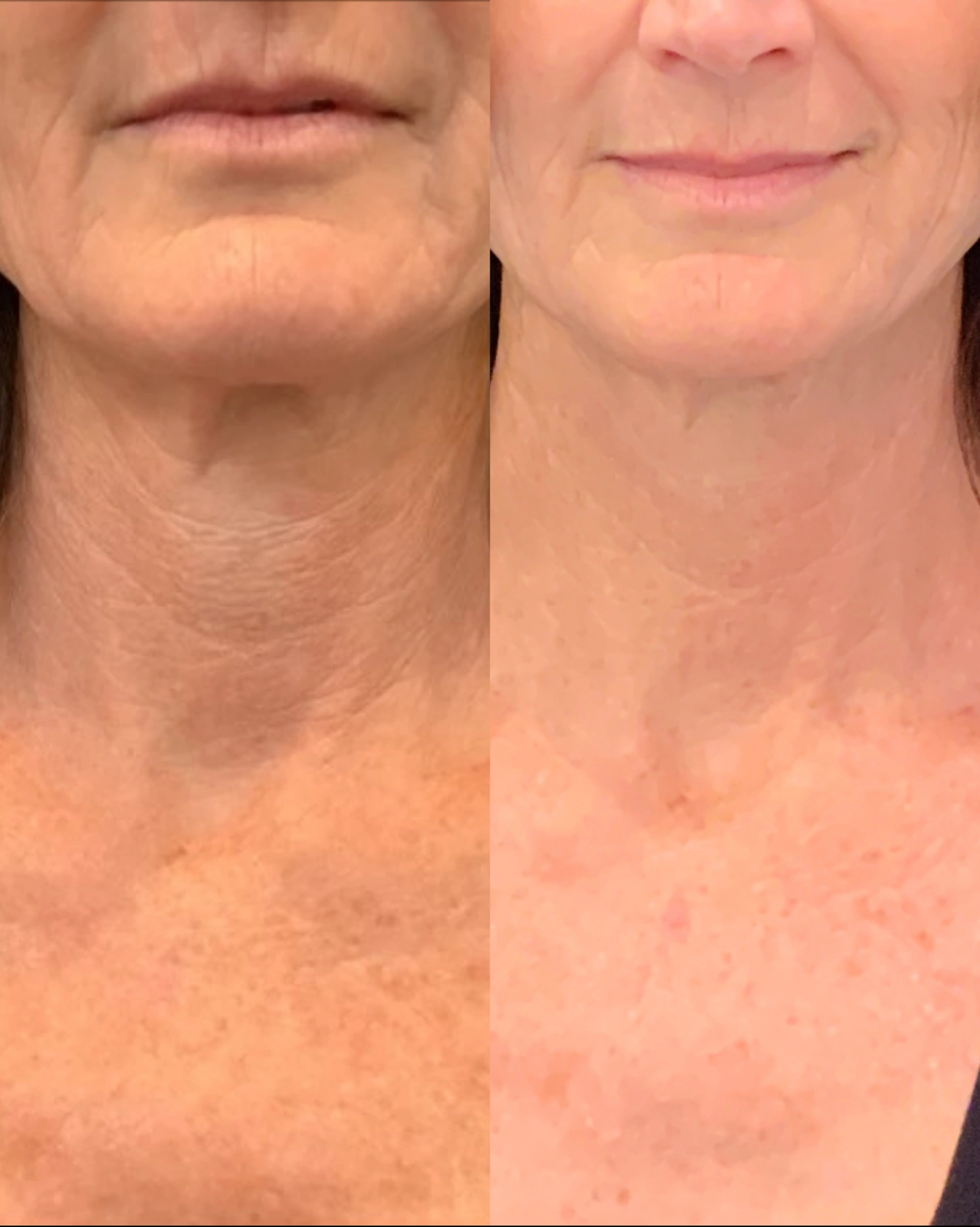 Real Patient Results by Motykie Med Spa serving Beverly Hills & Los Angeles, CA