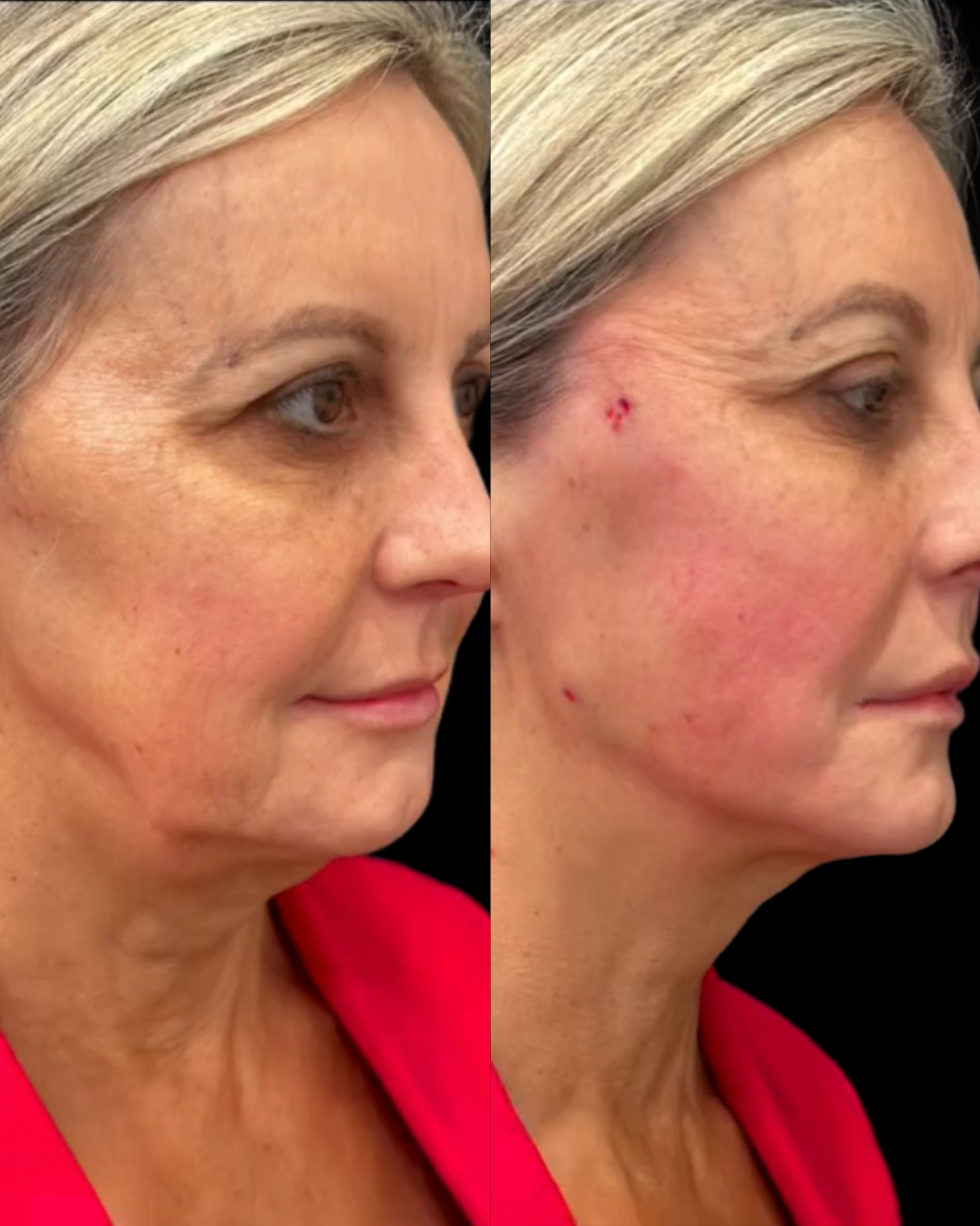 Real Patient Results by Motykie Med Spa serving Beverly Hills & Los Angeles, CA