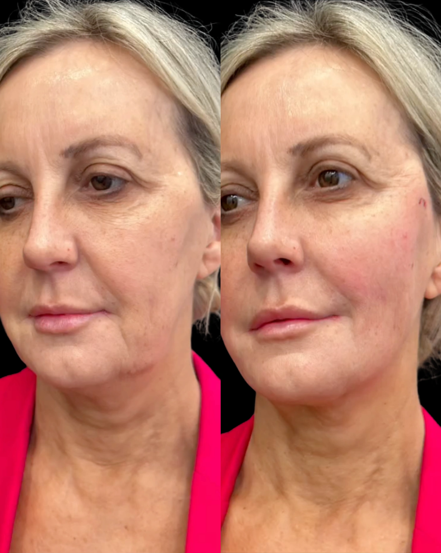 Real Patient Results by Motykie Med Spa serving Beverly Hills & Los Angeles, CA