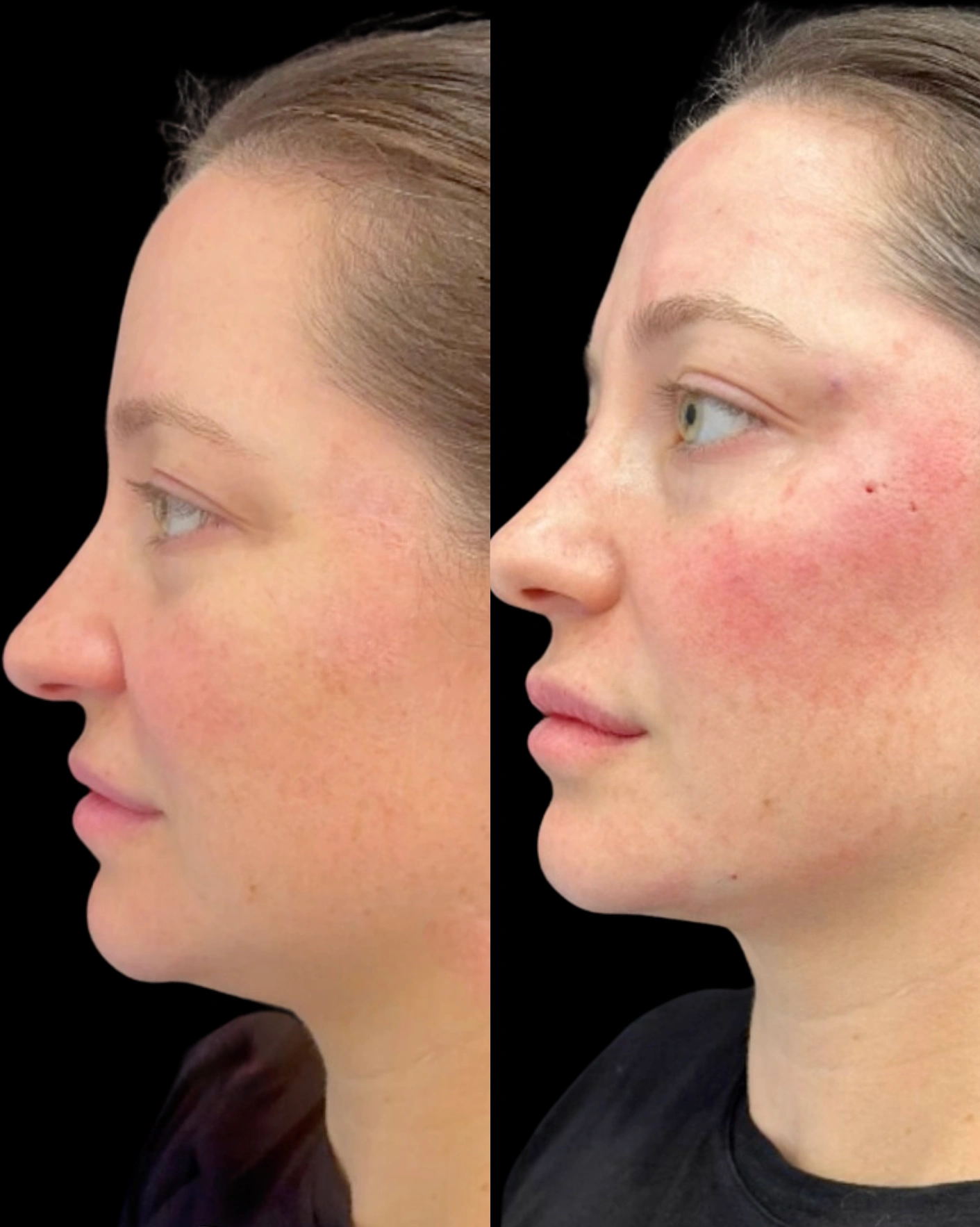 Real Patient Results by Motykie Med Spa serving Beverly Hills & Los Angeles, CA