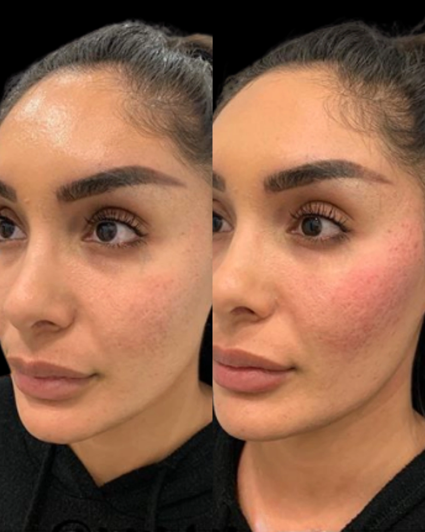 Real Patient Results by Motykie Med Spa serving Beverly Hills & Los Angeles, CA