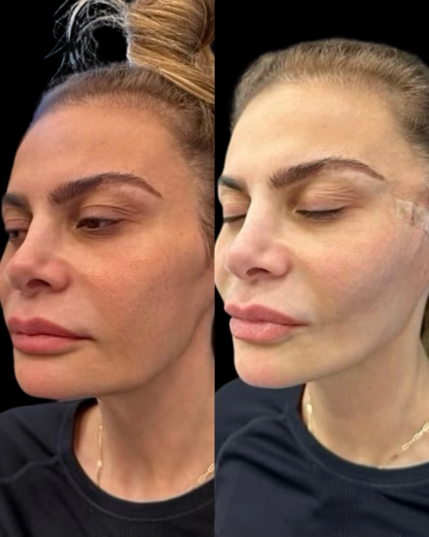 Real Patient Results by Motykie Med Spa serving Beverly Hills & Los Angeles, CA