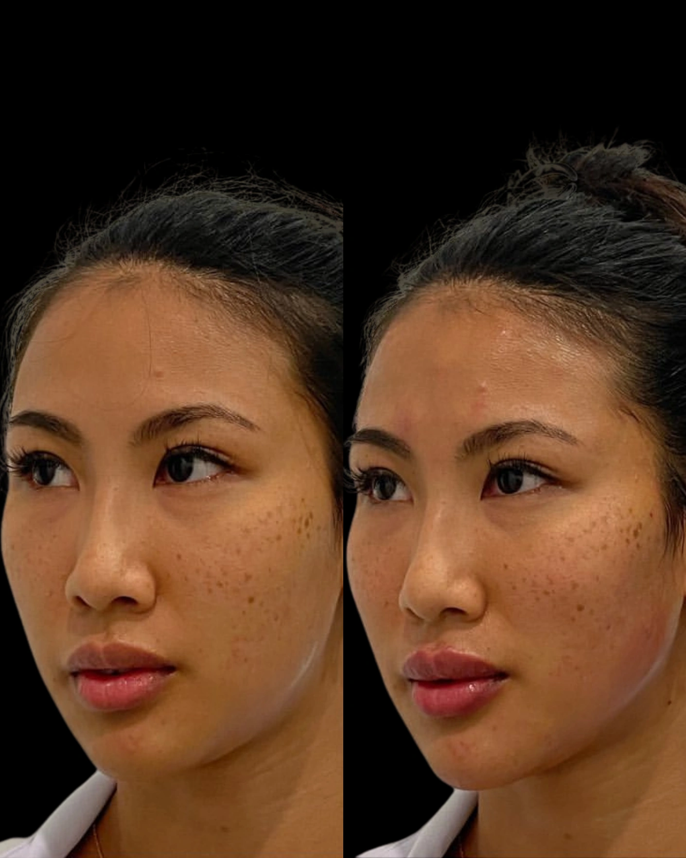 Real Patient Results by Motykie Med Spa serving Beverly Hills & Los Angeles, CA