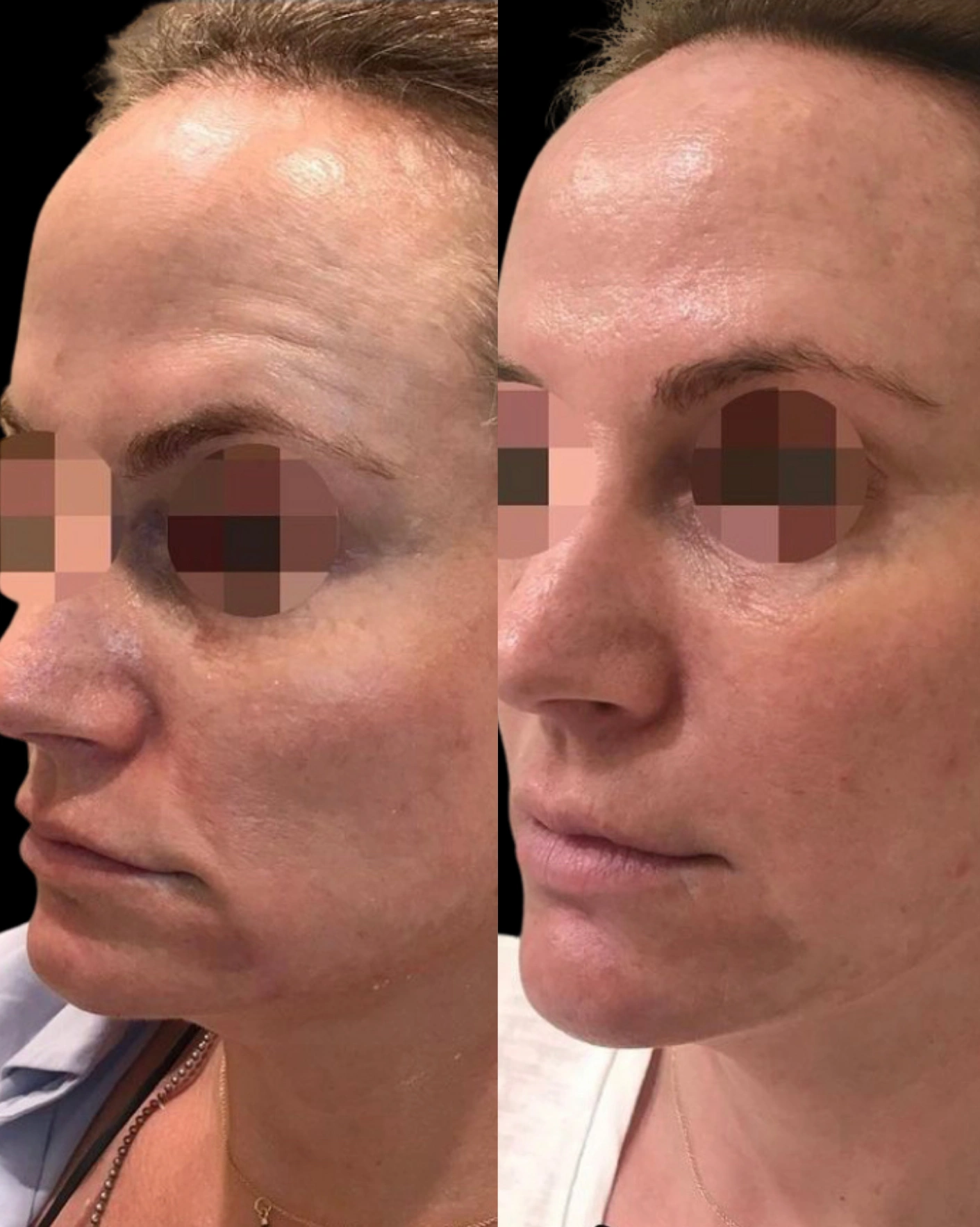 Real Patient Results by Motykie Med Spa serving Beverly Hills & Los Angeles, CA