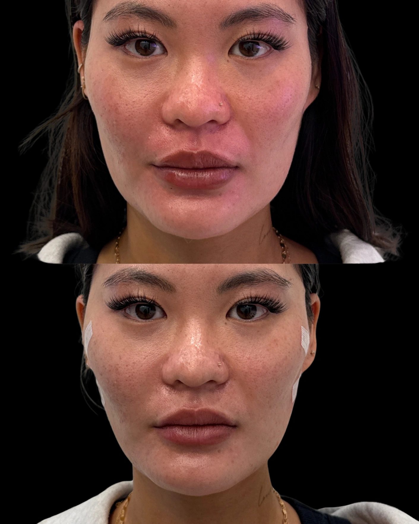 Real Patient Results by Motykie Med Spa serving Beverly Hills & Los Angeles, CA