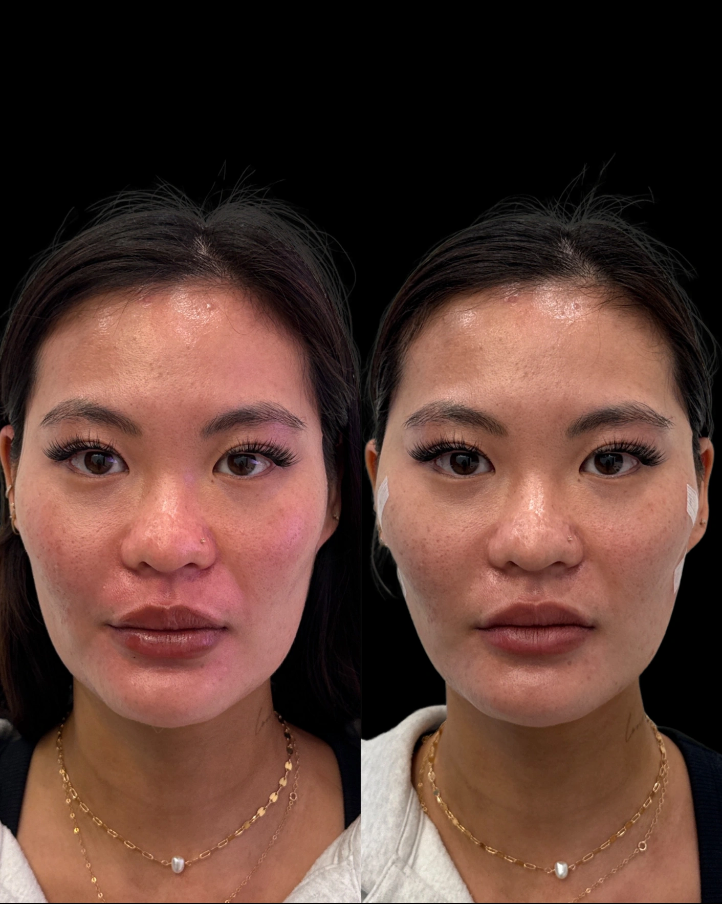 Real Patient Results by Motykie Med Spa serving Beverly Hills & Los Angeles, CA