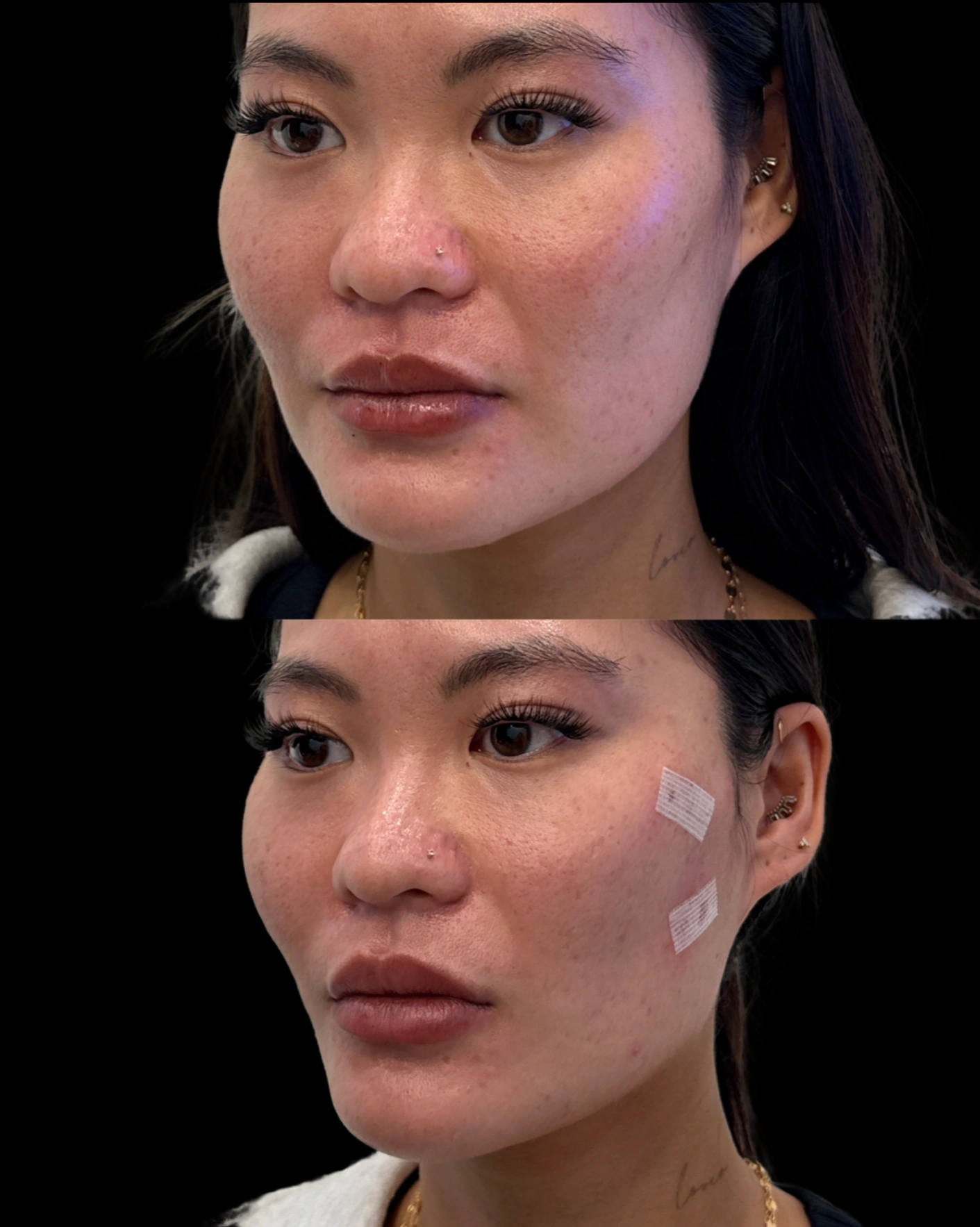 Real Patient Results by Motykie Med Spa serving Beverly Hills & Los Angeles, CA