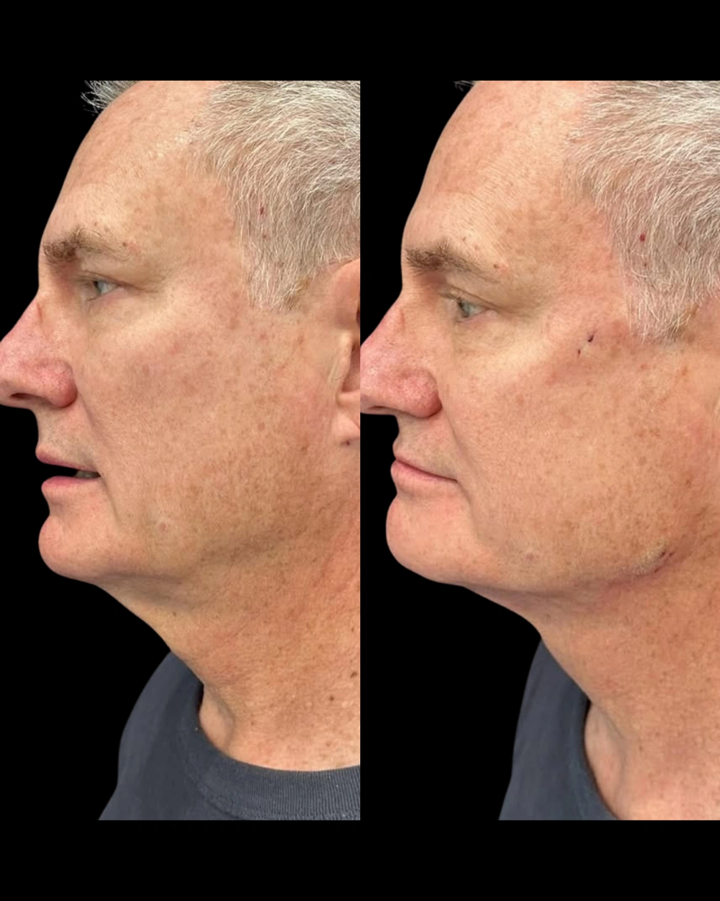 Real Patient Results by Motykie Med Spa serving Beverly Hills & Los Angeles, CA