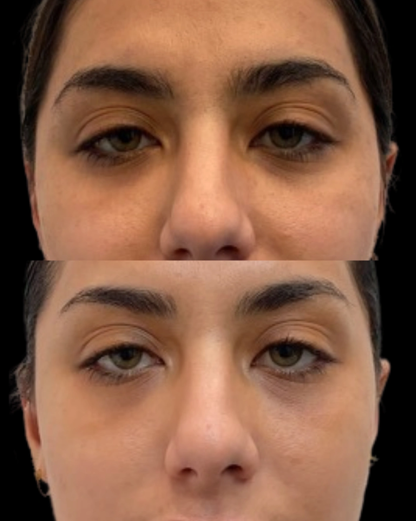 Real Patient Results by Motykie Med Spa serving Beverly Hills & Los Angeles, CA