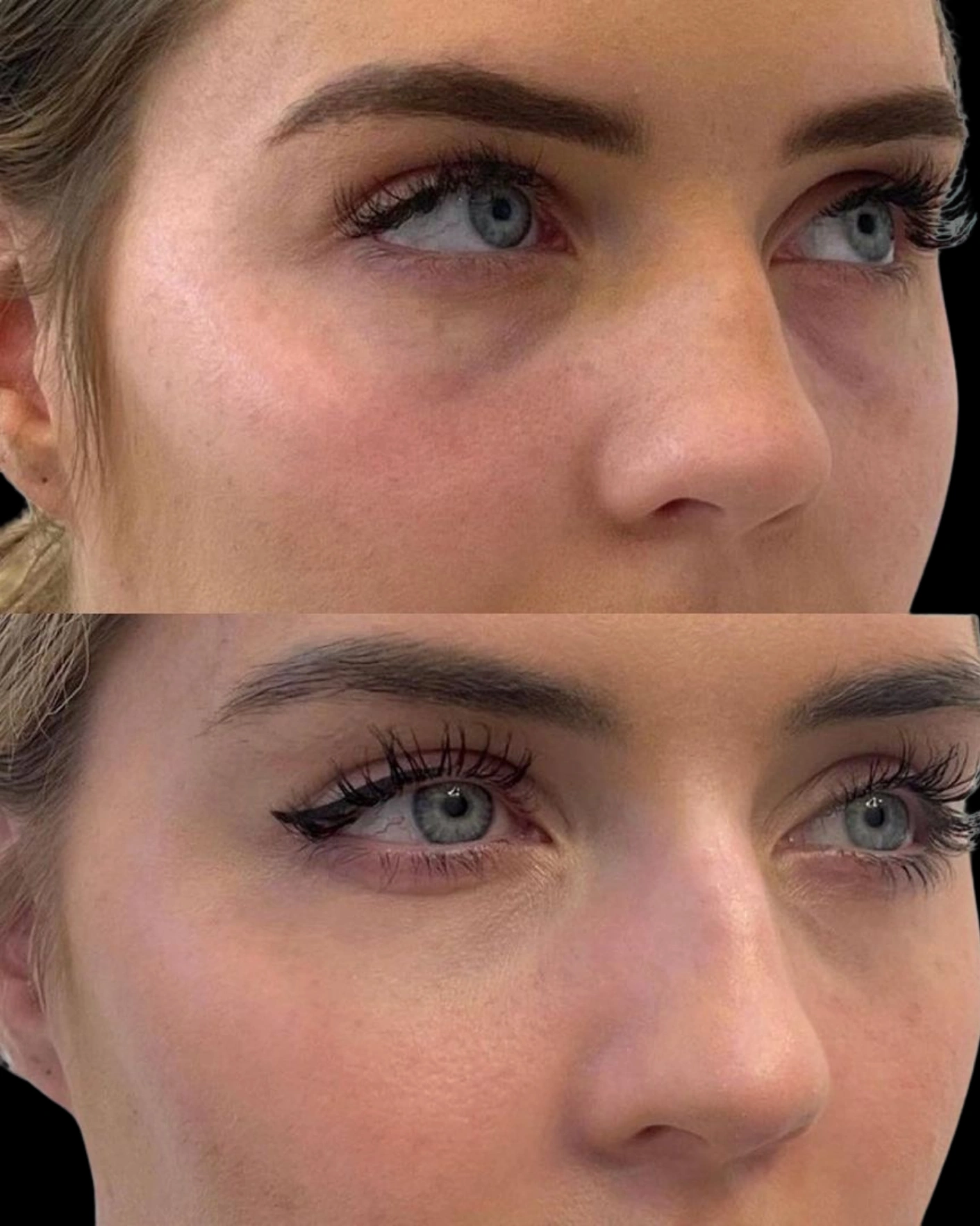 Real Patient Results by Motykie Med Spa serving Beverly Hills & Los Angeles, CA