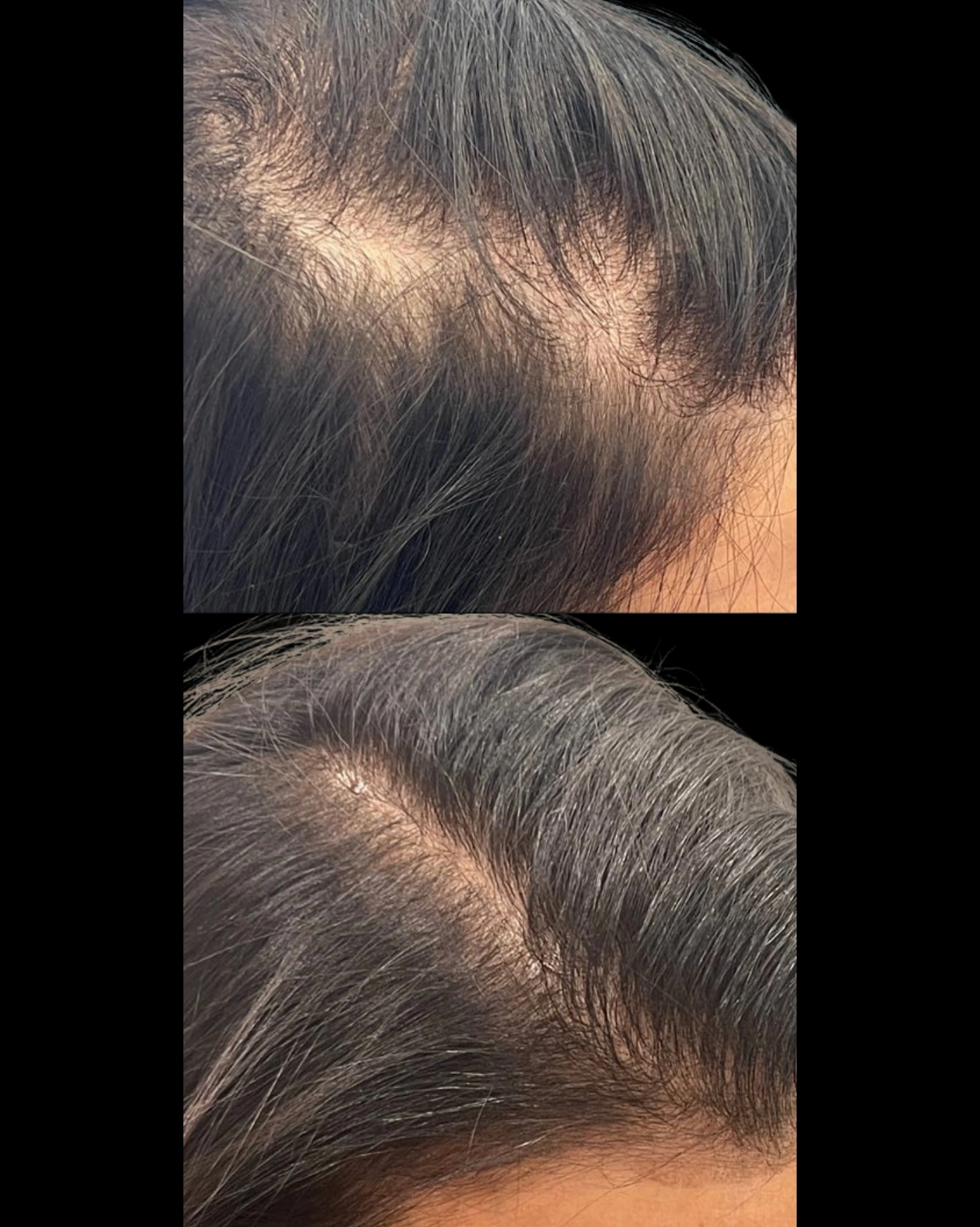 Real Patient Results by Motykie Med Spa serving Beverly Hills & Los Angeles, CA