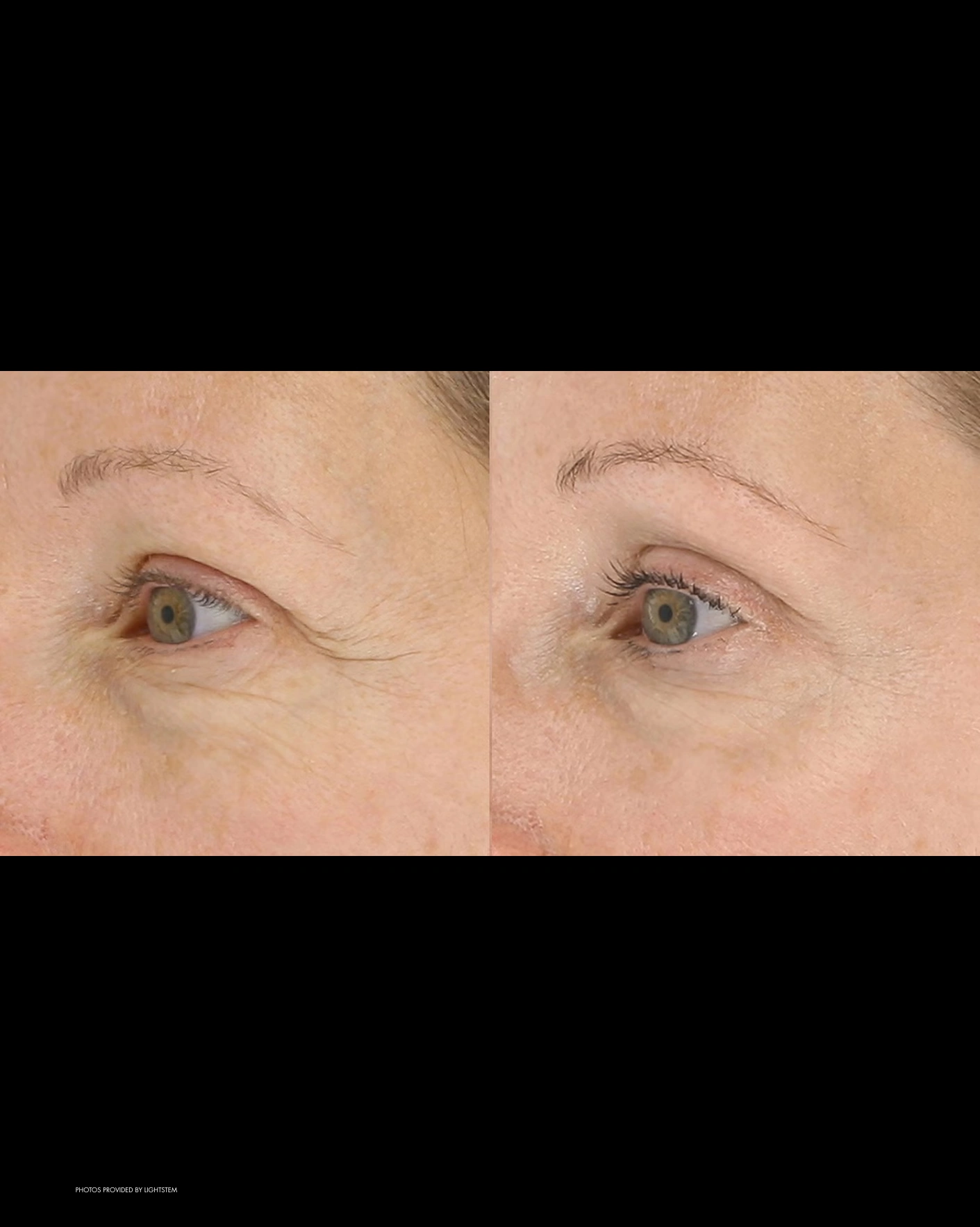 Real Patient Results by Motykie Med Spa serving Beverly Hills & Los Angeles, CA