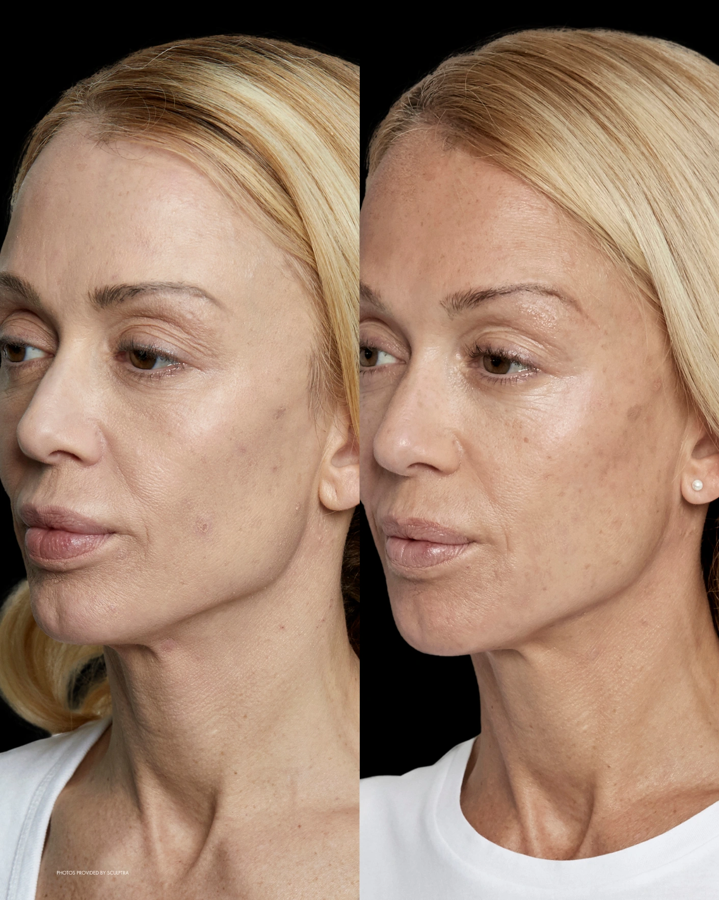 Real Patient Results by Motykie Med Spa serving Beverly Hills & Los Angeles, CA