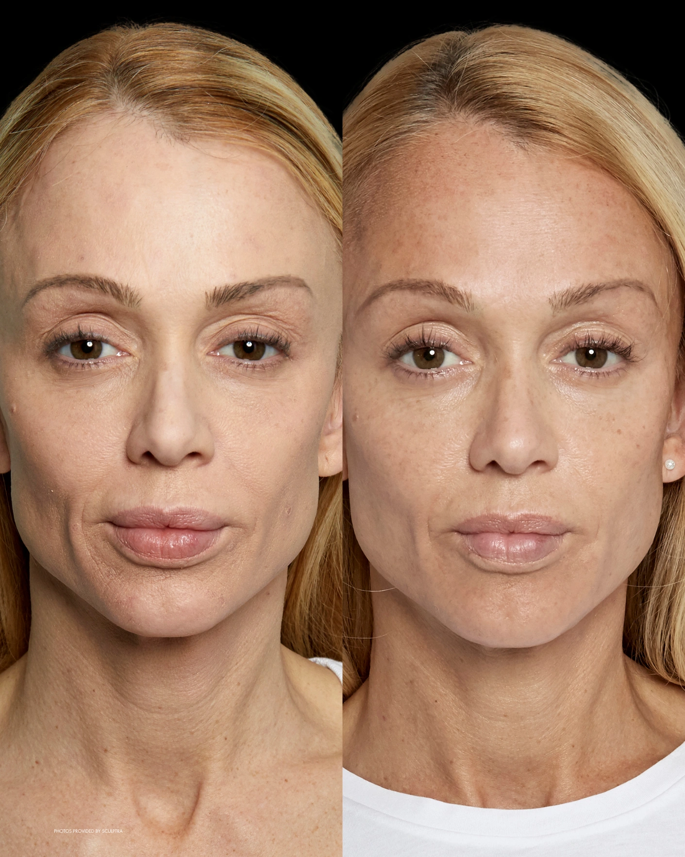 Real Patient Results by Motykie Med Spa serving Beverly Hills & Los Angeles, CA