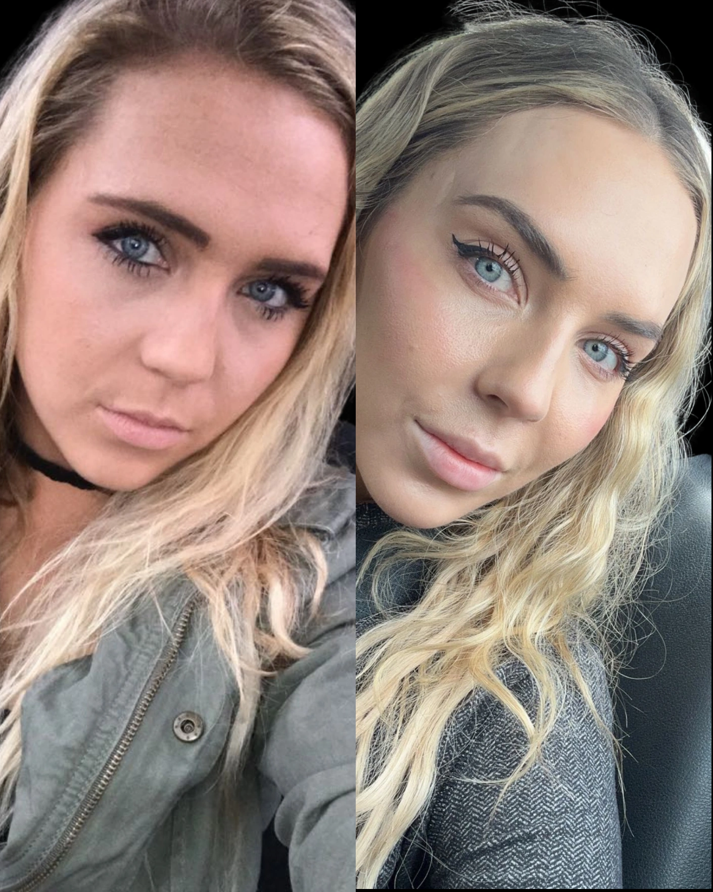 Real Patient Results by Motykie Med Spa serving Beverly Hills & Los Angeles, CA