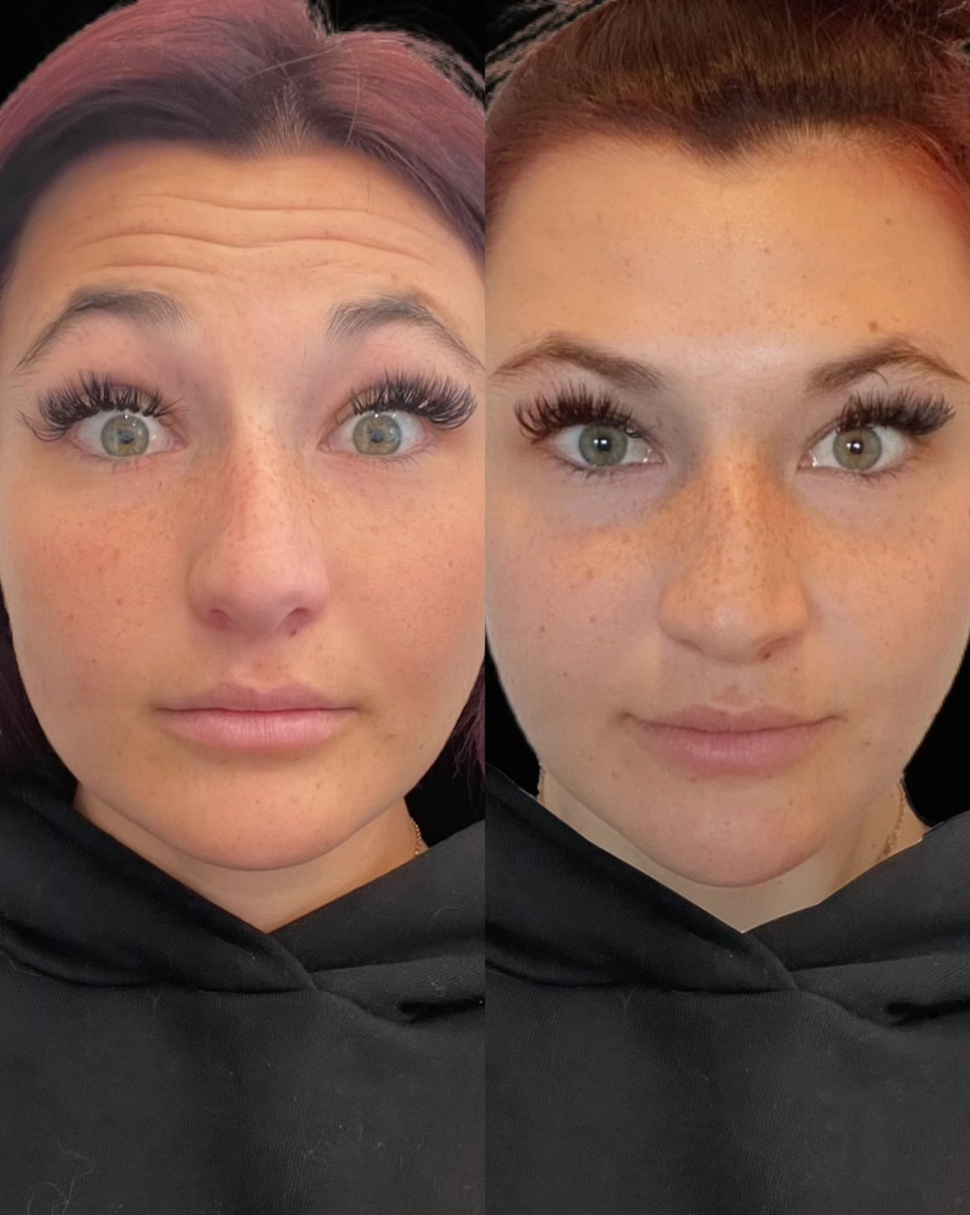 Real Patient Results by Motykie Med Spa serving Beverly Hills & Los Angeles, CA