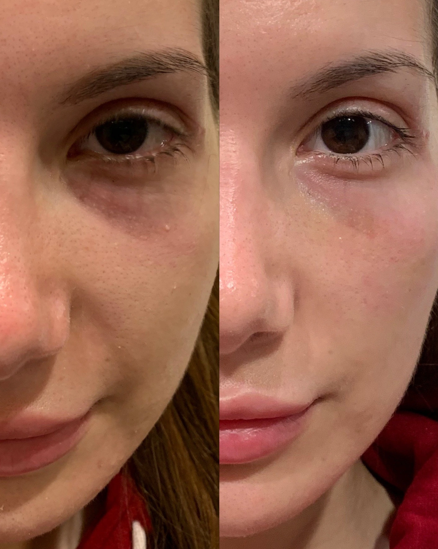 Real Patient Results by Motykie Med Spa serving Beverly Hills & Los Angeles, CA