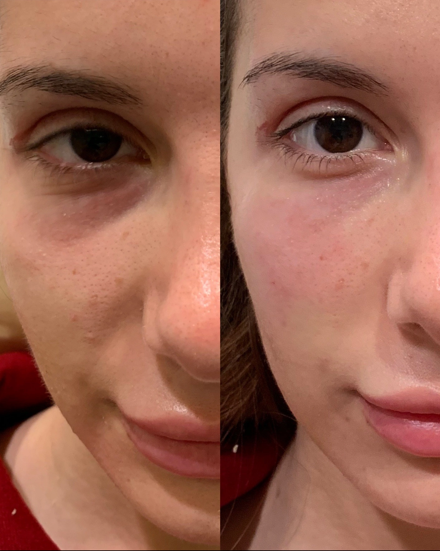 Real Patient Results by Motykie Med Spa serving Beverly Hills & Los Angeles, CA