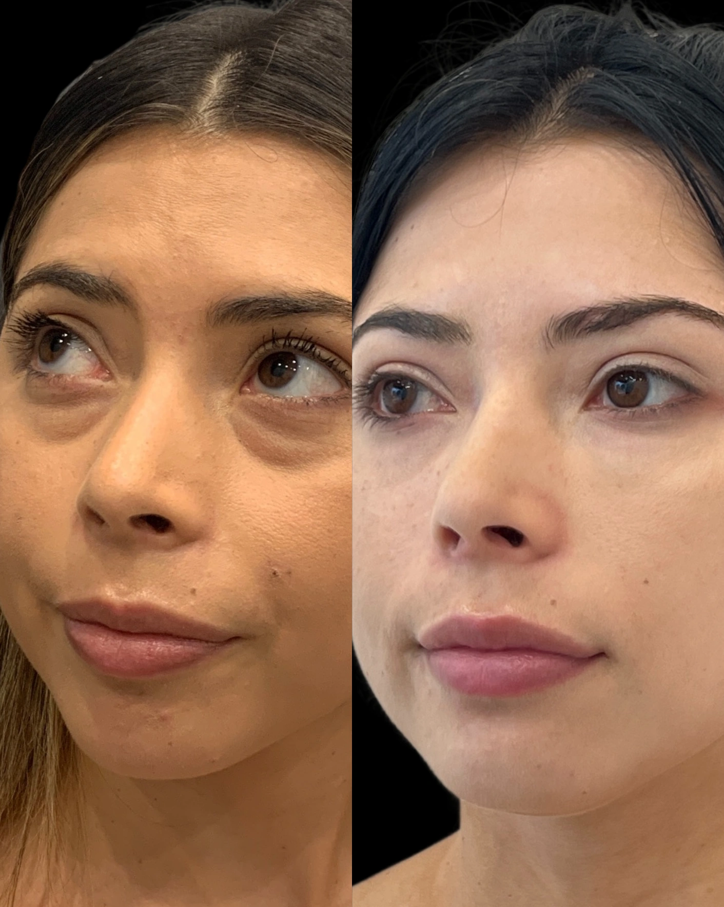 Real Patient Results by Motykie Med Spa serving Beverly Hills & Los Angeles, CA
