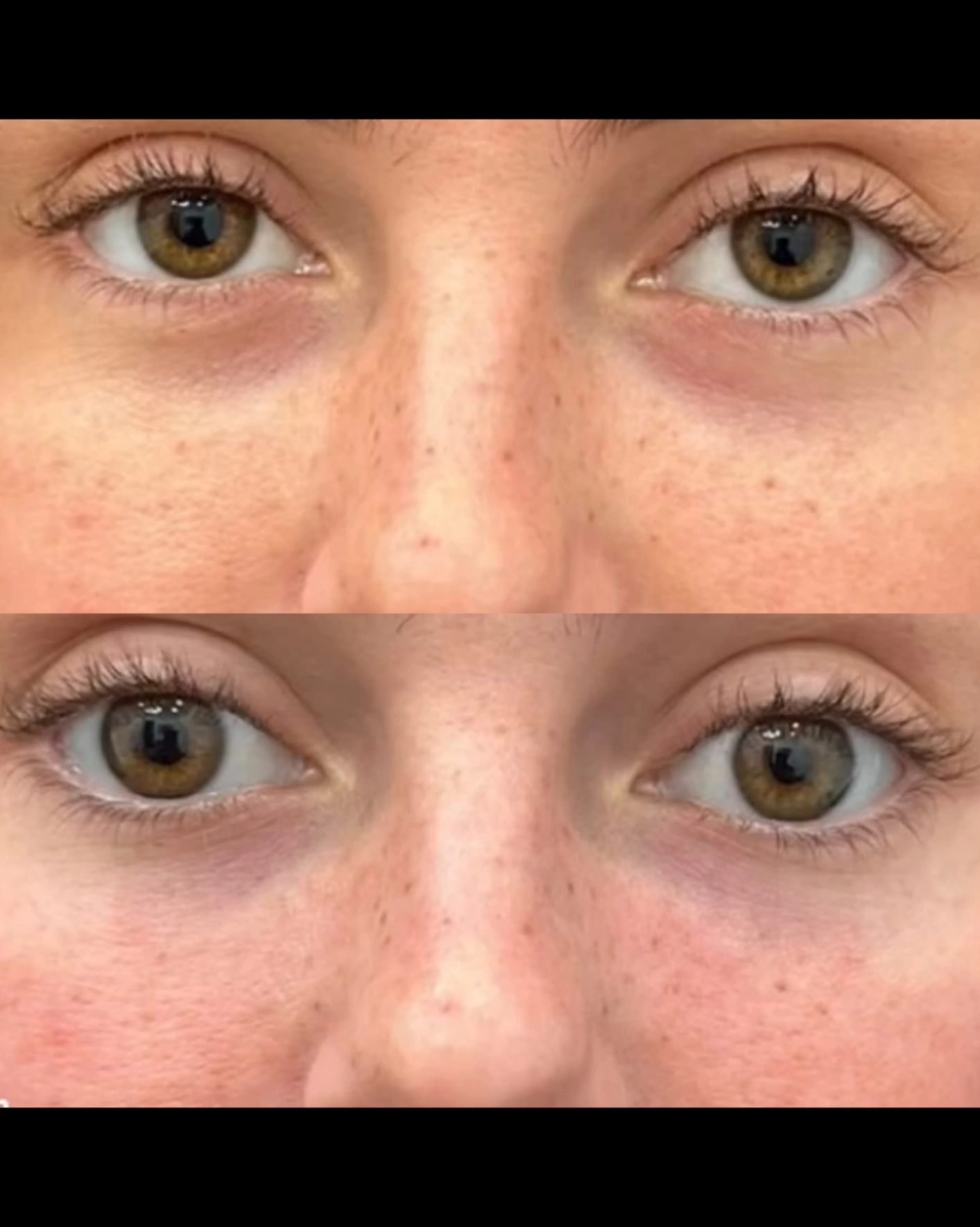 Real Patient Results by Motykie Med Spa serving Beverly Hills & Los Angeles, CA