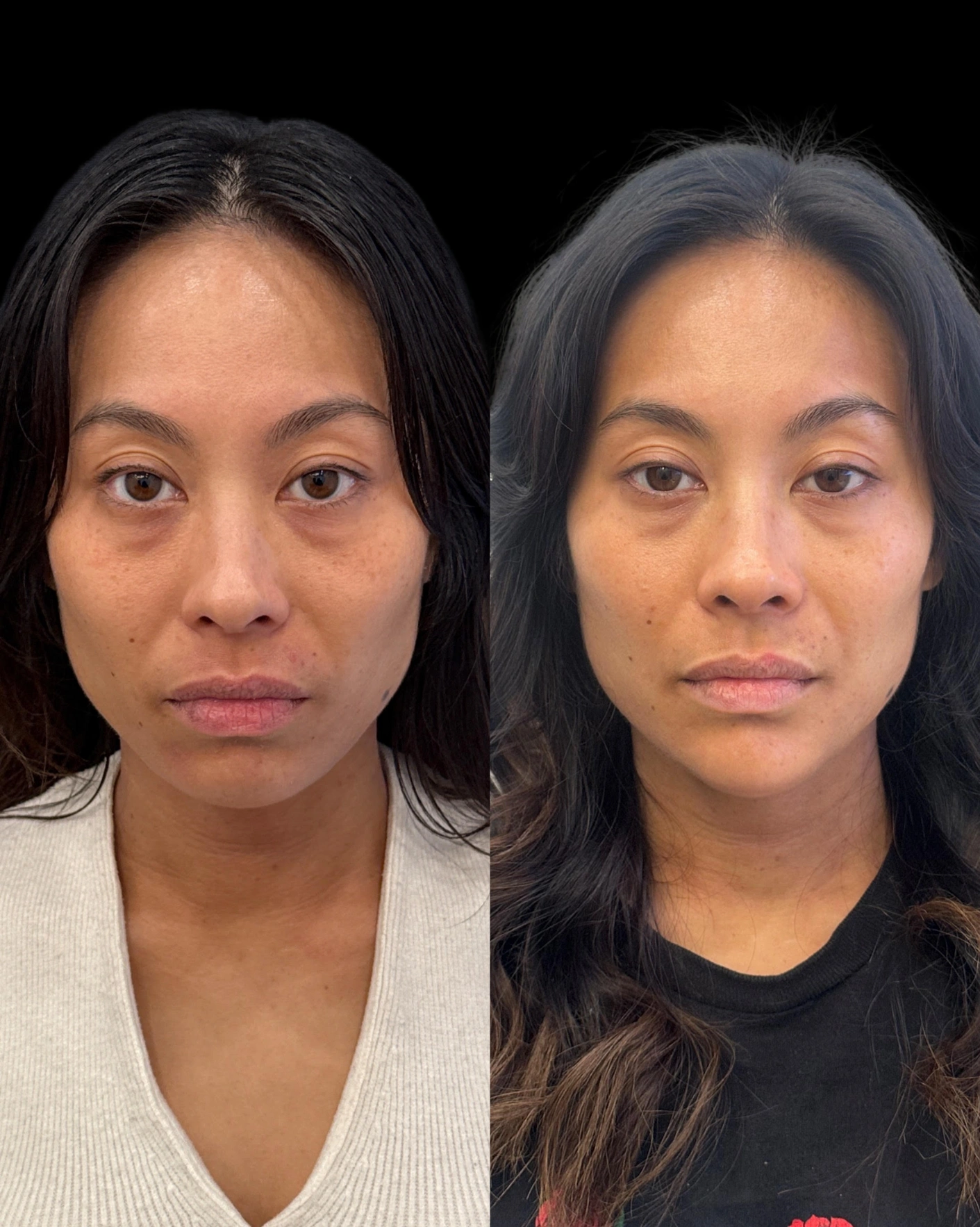 Real Patient Results by Motykie Med Spa serving Beverly Hills & Los Angeles, CA