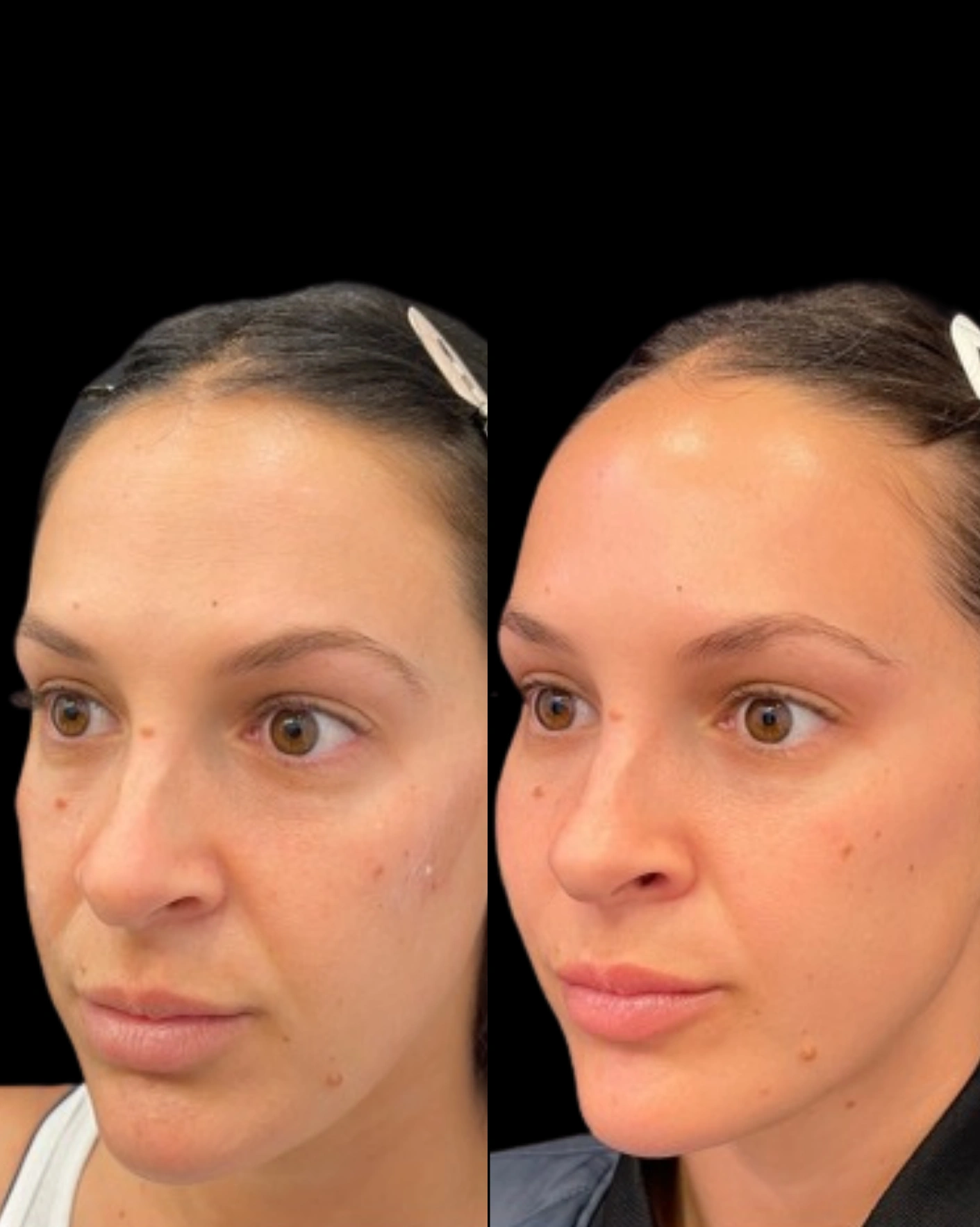 Real Patient Results by Motykie Med Spa serving Beverly Hills & Los Angeles, CA