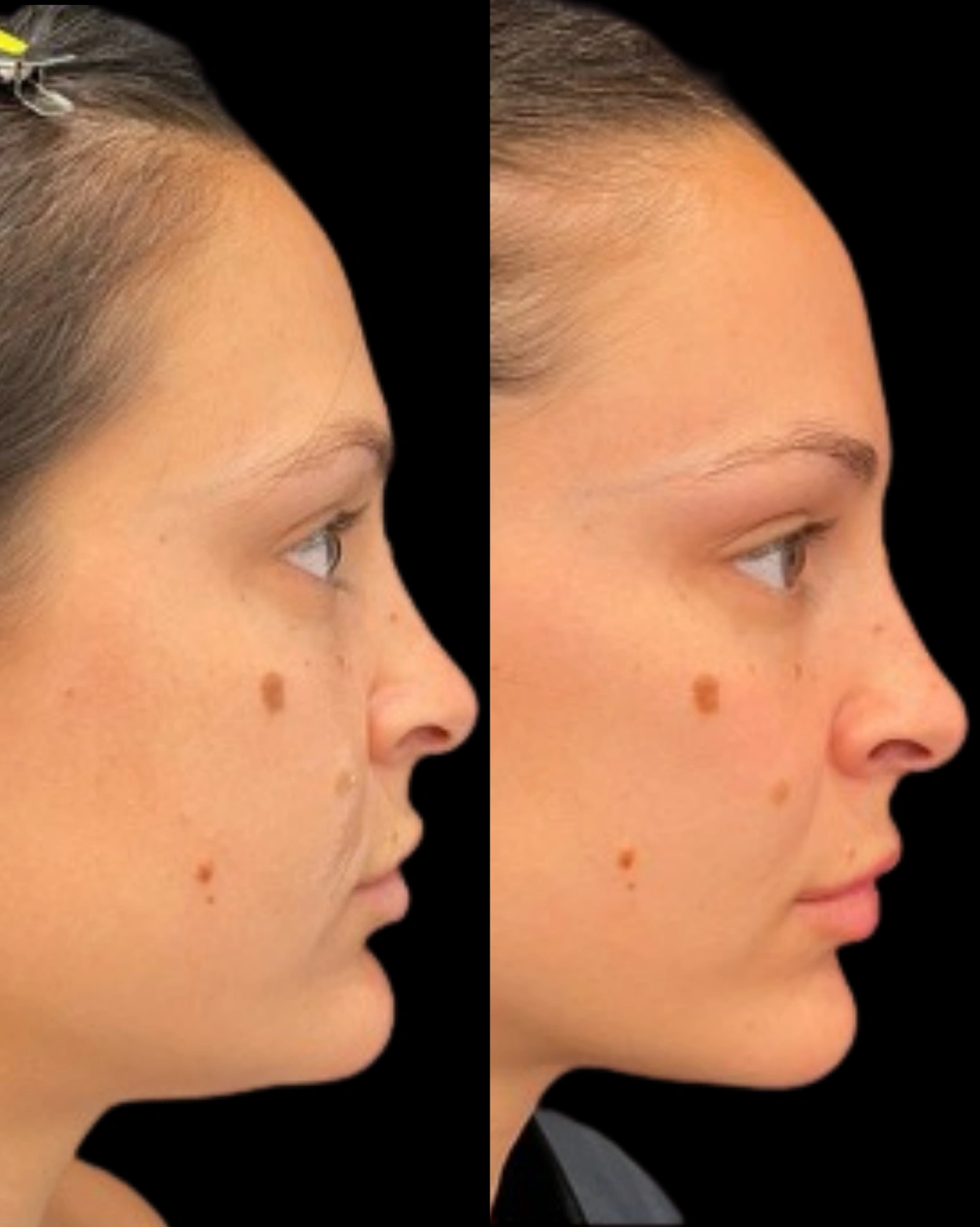 Real Patient Results by Motykie Med Spa serving Beverly Hills & Los Angeles, CA