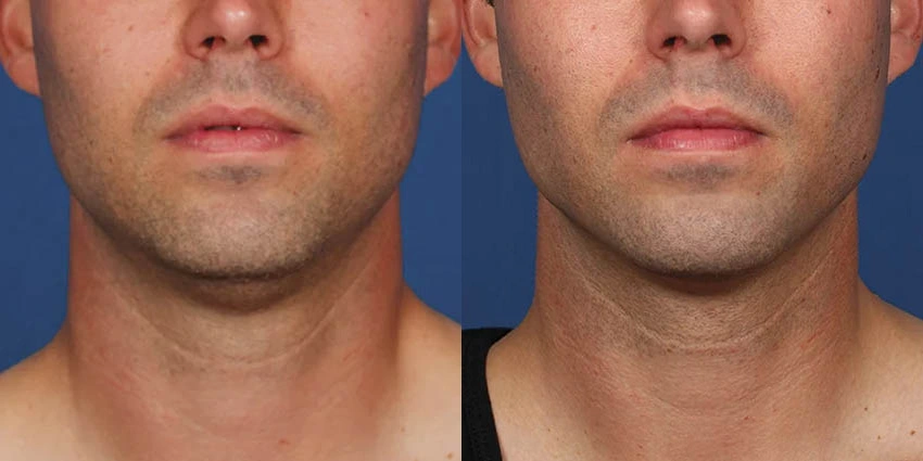 Real Patient Results of Motykie Med Spa serving West Hollywood & Beverly Hills, CA