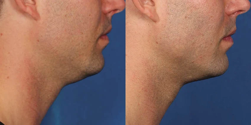 Real Patient Results of Motykie Med Spa serving West Hollywood & Beverly Hills, CA