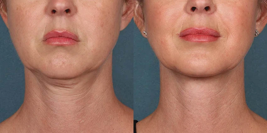 Real Patient Results of Motykie Med Spa serving West Hollywood & Beverly Hills, CA