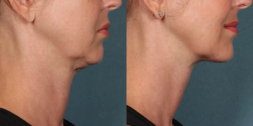 Real Patient Results of Motykie Med Spa serving West Hollywood & Beverly Hills, CA