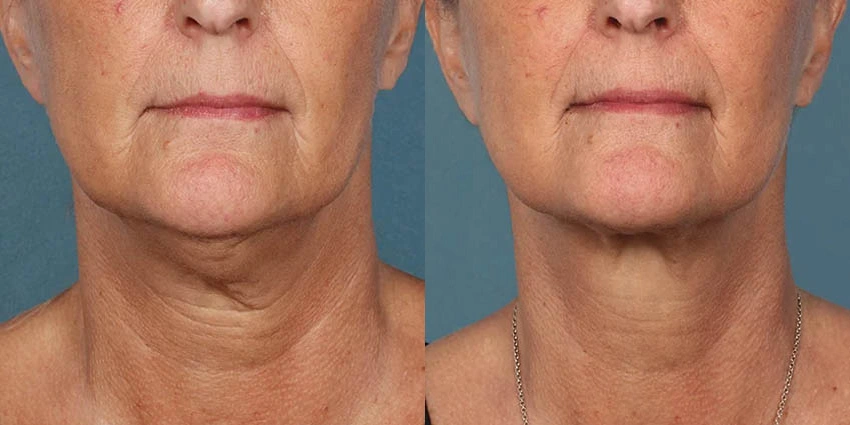 Real Patient Results of Motykie Med Spa serving West Hollywood & Beverly Hills, CA