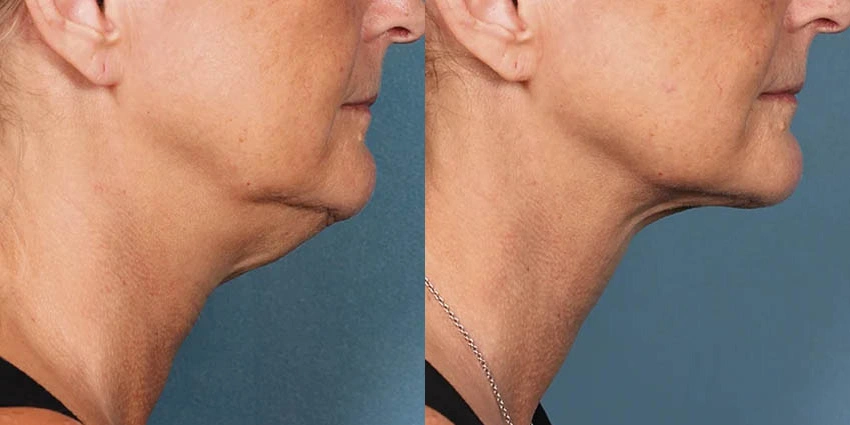 Real Patient Results of Motykie Med Spa serving West Hollywood & Beverly Hills, CA