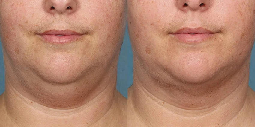 Real Patient Results of Motykie Med Spa serving West Hollywood & Beverly Hills, CA